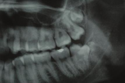 Process of the surgery of left fourth molar Case 7 A 25-year-old patient referred to our clinic complained for pain in the posterior left area of the mandible.