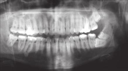 Left fourth and third molars impacted in the mandible Discussion In case of supernumerary teeth and especially in fourth molars early diagnosis, estimation of the present condition of both the