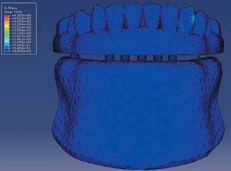 Patterns of disocclusion were simulated by applying a nodal load of 15 N with an angle of 45 to the canine tooth near implant 2.