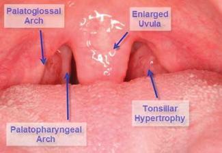 *The palatine tonsils, which are masses of lymphoid tissue, are located between the palatoglossal and palatopharyngeal arches.