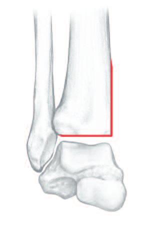 the medial malleolus tangent to