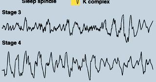 EEG - slow/absent eye movements - normal muscle tonus - no sexual activation - ponto-geniculo-occipital (PGO) waves absent - passive, less-detailed (static) dreams REM (paradoxical) sleep: - more