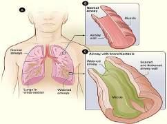 Bronchiectasis Dilated airways with frequently thickened walls Faculty/Presenter Disclosure Faculty: Dr.