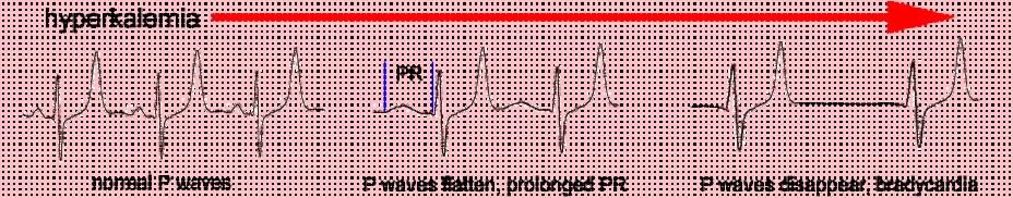 2- P wave changes Worsening hyperkalemia is associated with