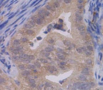 Representative images of immunohistochemical staining from Ade-Cre injected Pten loxp/loxp /Lkb1 loxp/loxp mice treated with (5 mg/kg/day,