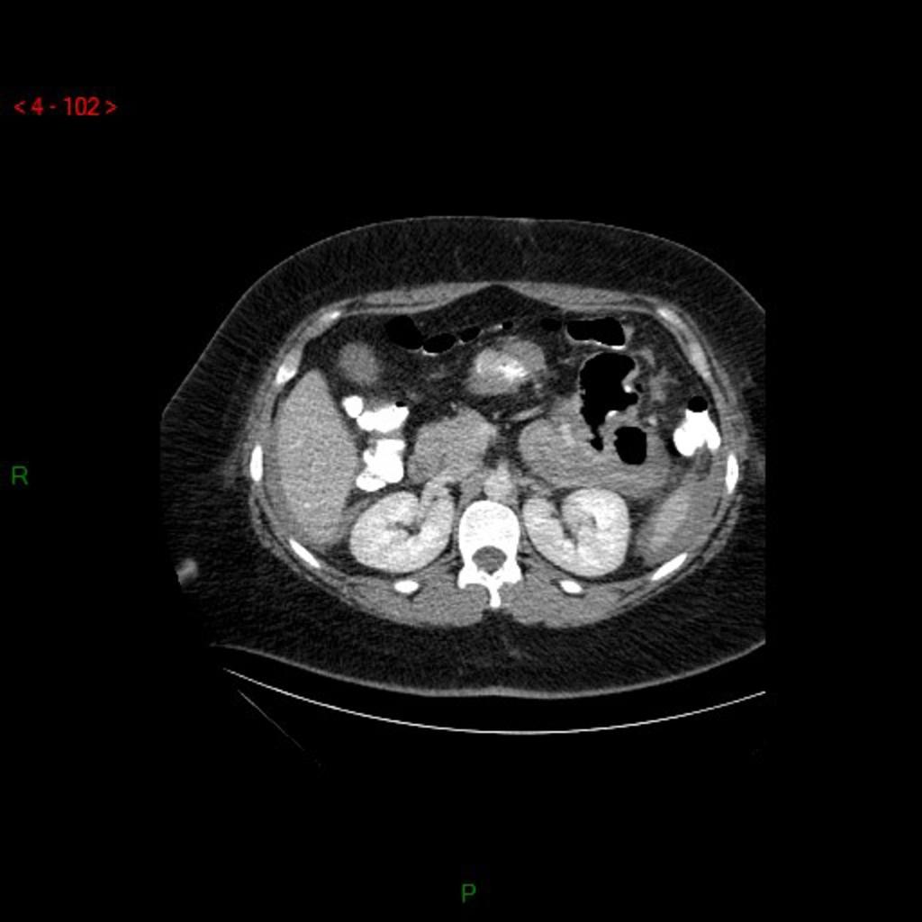 Fig. 10: Spontaneously dense extra gastric collection (60 UH) suggesting a