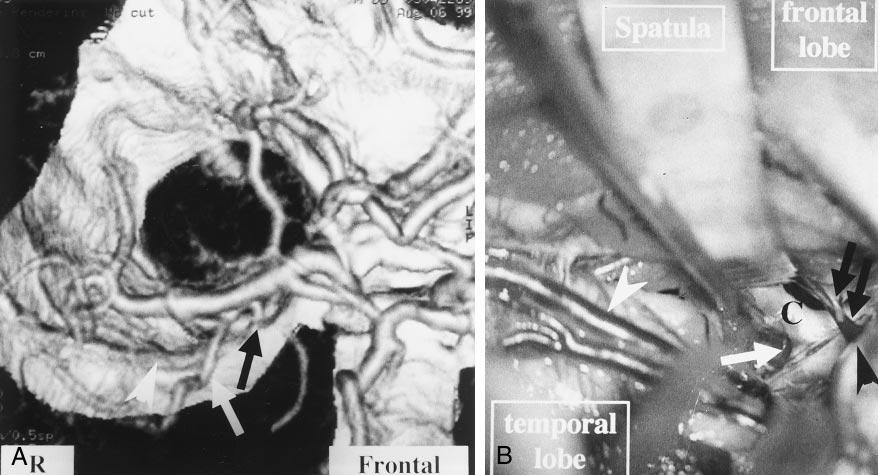 B, A microscopic operative photograph shows that the right frontal lobe was retracted by the spatula to expose the right internal carotid artery (C).