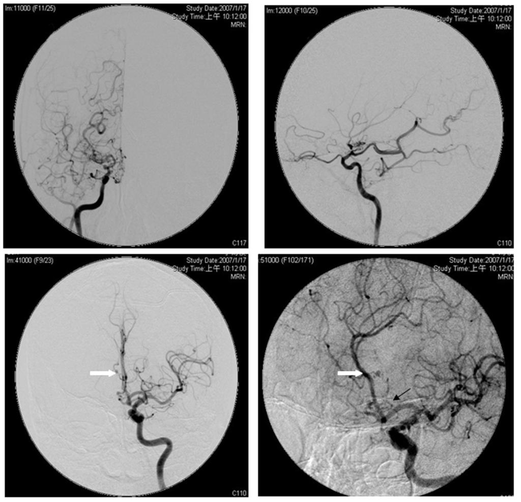 543 Cheng-Chi Lee, et al the aneurysm involving the accessory MCA artery was performed.