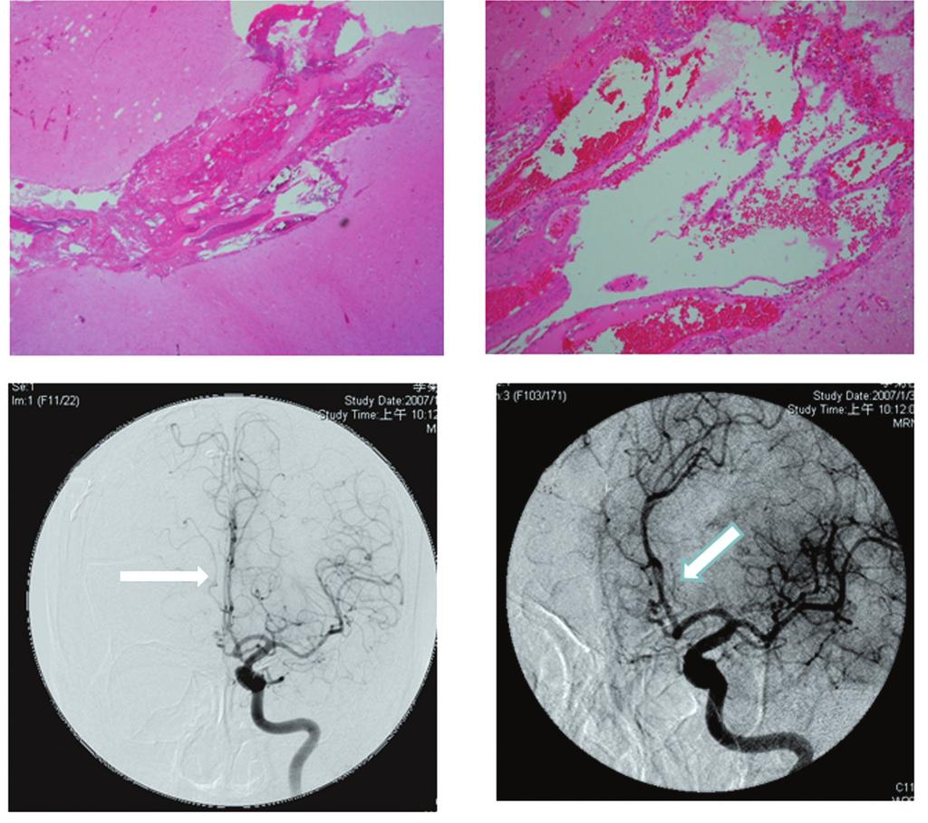 Cheng-Chi Lee, et al 544 A B C D Fig. 3 Pathology and follow-up angiography.