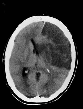 Patient with large MCA stroke: 24