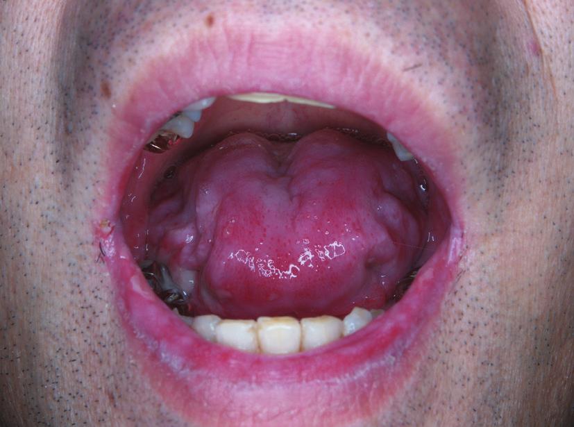 2 Dermatology Research and Practice 100 μm Figure 1: Blisters and on the buccal mucosa, tongue, and lips. Oral lesions did not extend onto the vermillion of the lips.