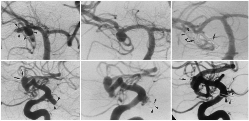 K. Kinugasa, et al. FIG. 4. Upper Left: Case 7. Right internal carotid artery angiogram showing a multilobed aneurysm (arrowheads) at the trifurcation of the middle cerebral artery (MCA).