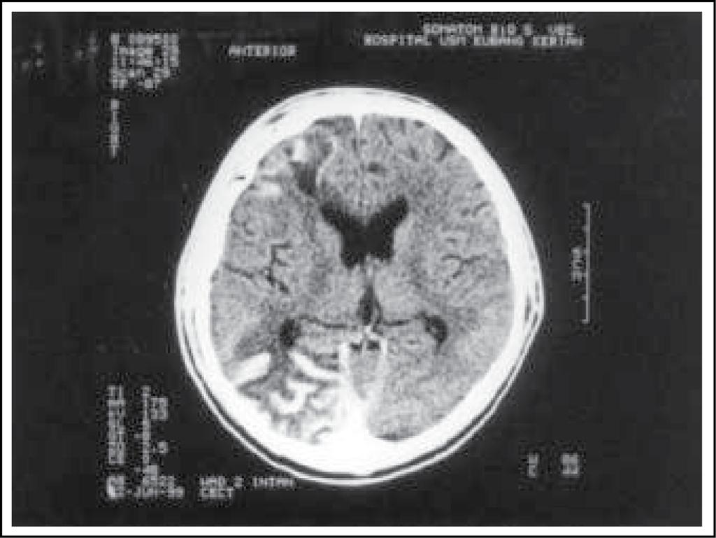 Yong Pei Yee, Ibrahim Lutfi Shuaib, Jafri Malin Abdullah 48 Figure 1 : Plain CT brain showing focal gliosis of the right frontal and right