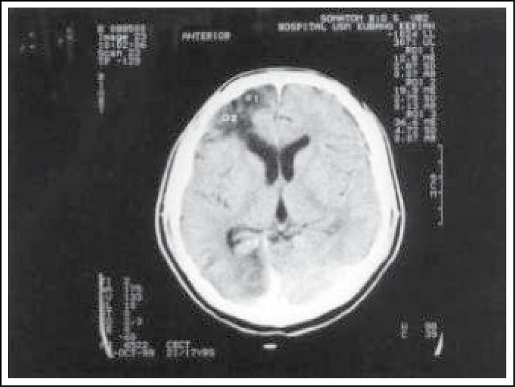ARTERIOVENOUS MALFORMATION OR CONTUSION : A DIAGNOSTIC DILEMMA of arteriovenous malformation was raised and cerebral angiography was suggested.