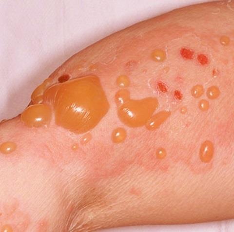 Skin Toxicities Common 30-50% Range of presentations Maculopapular