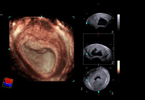 The ACUSON S2000 Automated Breast Volume Scanner is the first multi-use ultrasound system that enables acquisition, analysis and reporting on full-field volumes of intricate breast anatomy and
