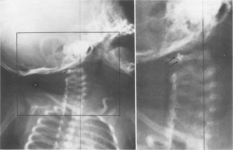 Telescopic ventriculoatrial shunt Ftr 3. Left: Radiograph of child taken I week after implantation of telescopic shunt.