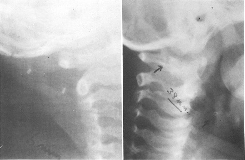 I F and G) are shown overlying C-I vertebra (arrows). FJ(;. 4. Left. Enlargement of radiograph of same patient as in Fig.