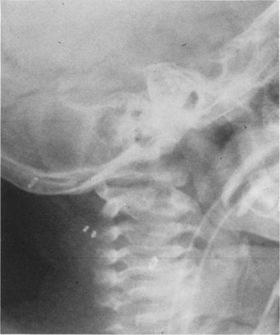 Burton L. Wise Ft(;. 5. Radiograph of patient with newer model of shunt, which has radiopaque markers at either end of outer cylinder, 5 cm apart.