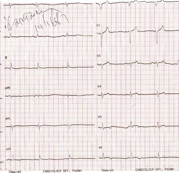 Man, 34 year-old Low QRS voltage