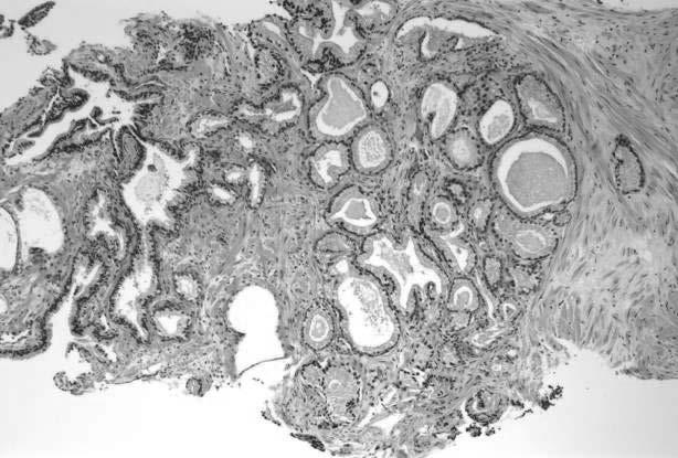 Cancers Mimicking Benign Glandular Proliferations Pseudohyperplastic prostate cancer Foamy gland prostate cancer Atrophic prostate cancer