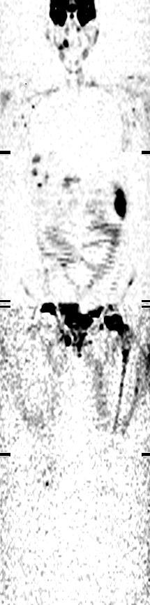 CASES Case 1 WB MRI
