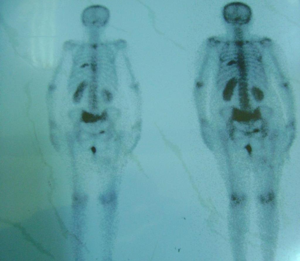 Bone Scan Case 2 Multiple infiltrative osseous lesions at