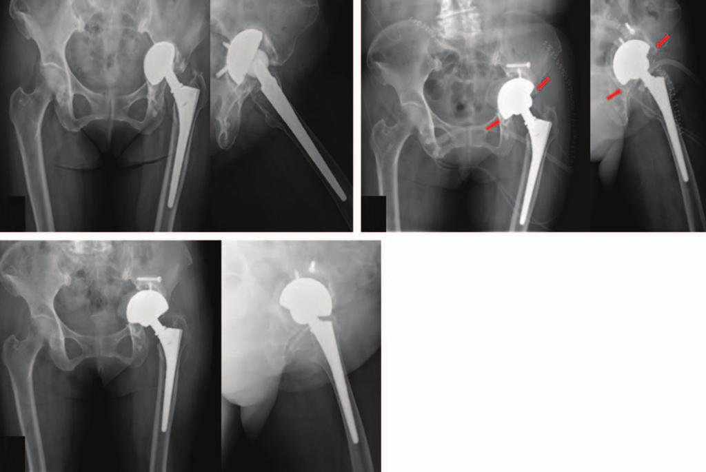 Woo-Lam Jo et al. Peripheral Rim Fixation with Jumbo Cup in Revisional Hip Arthroplasty A B C Fig. 2. (A) A female aged 71 years had acetabular protrusion of previous acetabular component.
