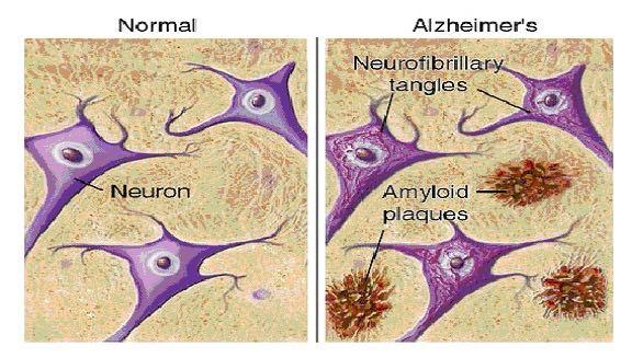 Drugs used Alzheimer s disease Dementia in Alzheimer involves accumulation