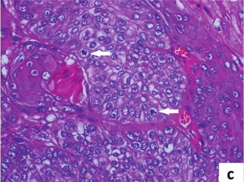 The histopathological evaluation found solid islands standing back-to-back in a desmoplastic basement and a neoplastic formation composed of epithelial cells that were designed in a cordon-like
