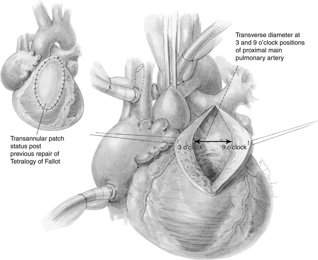 PTFE bicuspid pulmonary valve implantation 245 Operative Technique Figure 1 Implantation is performed using cardiopulmonary bypass usually with bicaval cannulation.
