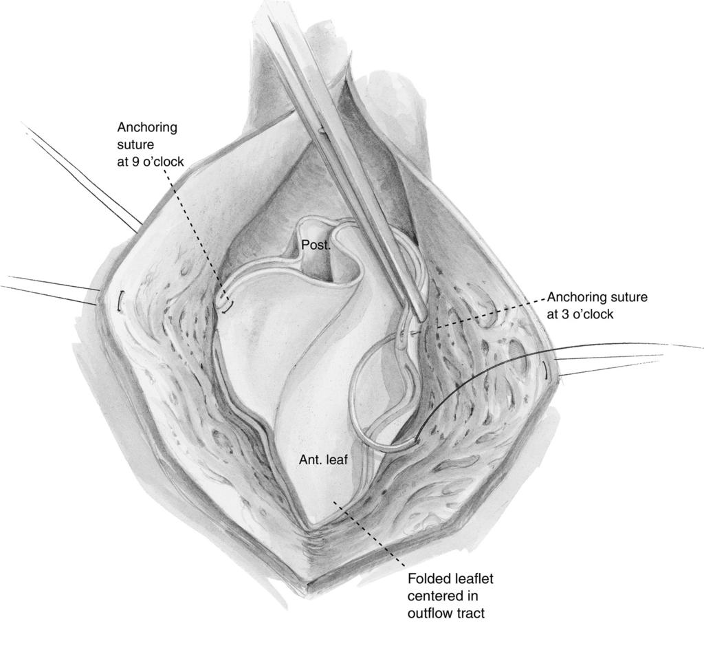 PTFE bicuspid pulmonary valve implantation 247 Figure 3 Implantation is begun by placing two 5-0 Prolene mattress anchoring sutures through the corners of the outlet end of