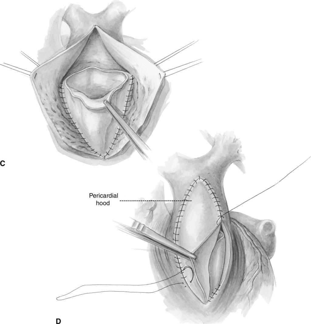 PTFE bicuspid pulmonary valve implantation 249 Figure 4 (Continued) References 1. Bouzas B, Kilner PJ, Gatzoulis MA: Pulmonary regurgitation: not a benign lesion. Eur Heart J 26:433-439, 2005 2.