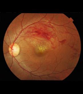 Central Retinal Vein Occlusion Thrombosis of Central Retinal Vein Risk