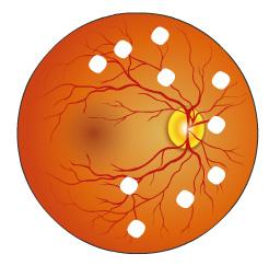 Eye doctors may see: Hemorrhages in the retina. Microaneurysms, or dilated blood vessels. Cotton wool spots, which are areas of poor circulation.