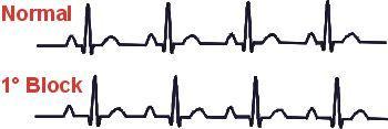 First-degree heart block Impulses are slowed, but they all successfully reach the ventricles P-R