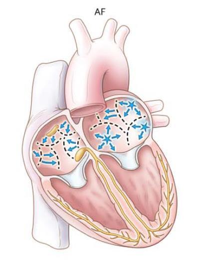 Atrial fibrillation Mechanism: Enhanced automaticity in multiple atrial foci Re-entry in multiple aberrant circuits Main underlying causes: Cardiac disease Pulmonary disease Hyperthyroidism