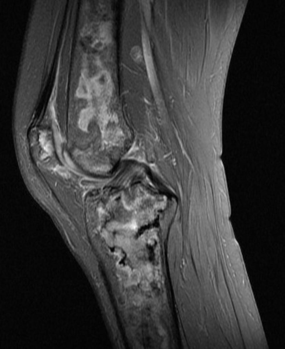Fig. 9: Sagittal fat saturated proton density image of the knee showing striking geographical areas of