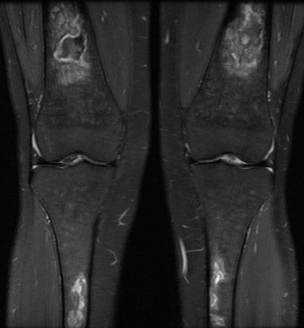 Fig. 11: Coronal fat saturated proton density image showing bilateral medullary osteonecrosis, both above and below the knee.