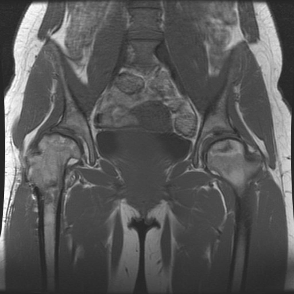 Fig. 12: Coronal T1w image showing bilateral avascular necrosis of the femoral heads.
