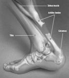 Rupture Palpate tendon defect