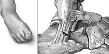 ligament Joint instability?
