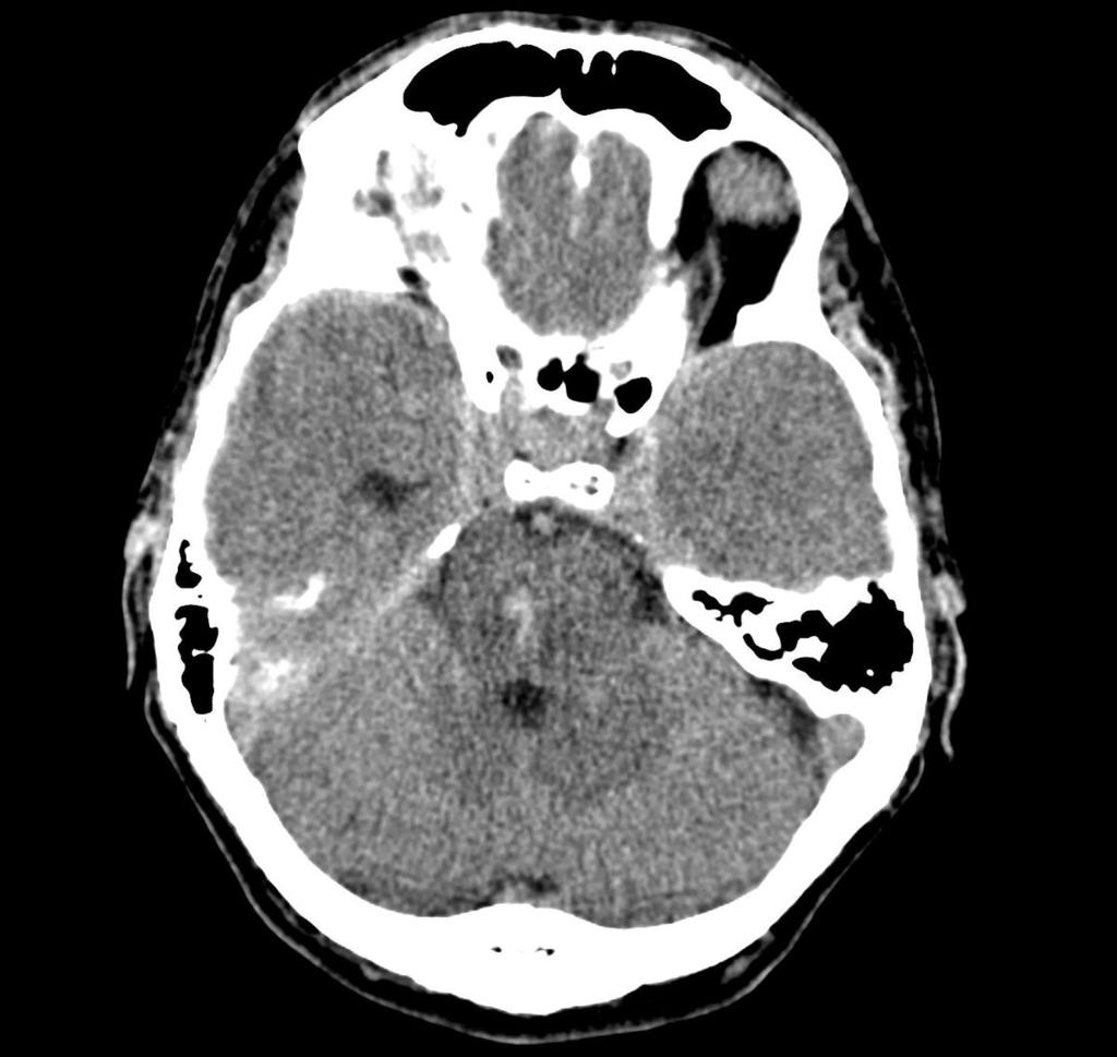Fig. 1: Midline hemorrhagic focus in the upper brainstem,