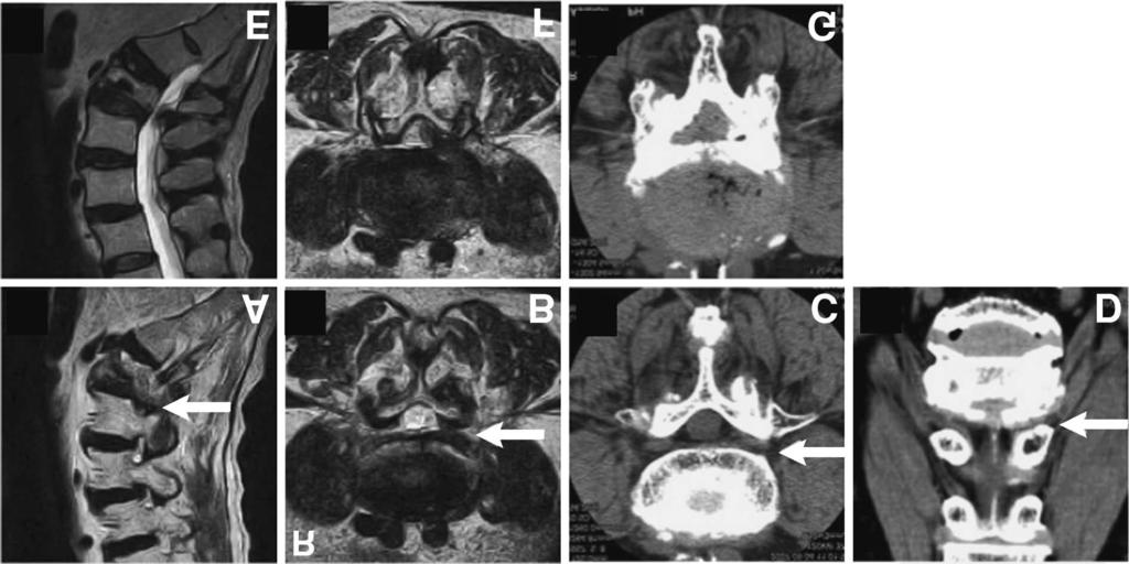 486 M. Sasaki et al. Fig. 1 Case 8. A, B: Preoperative T 2 -weighted magnetic resonance (MR) images showing left foraminal stenosis at the L4 5 level (arrow).