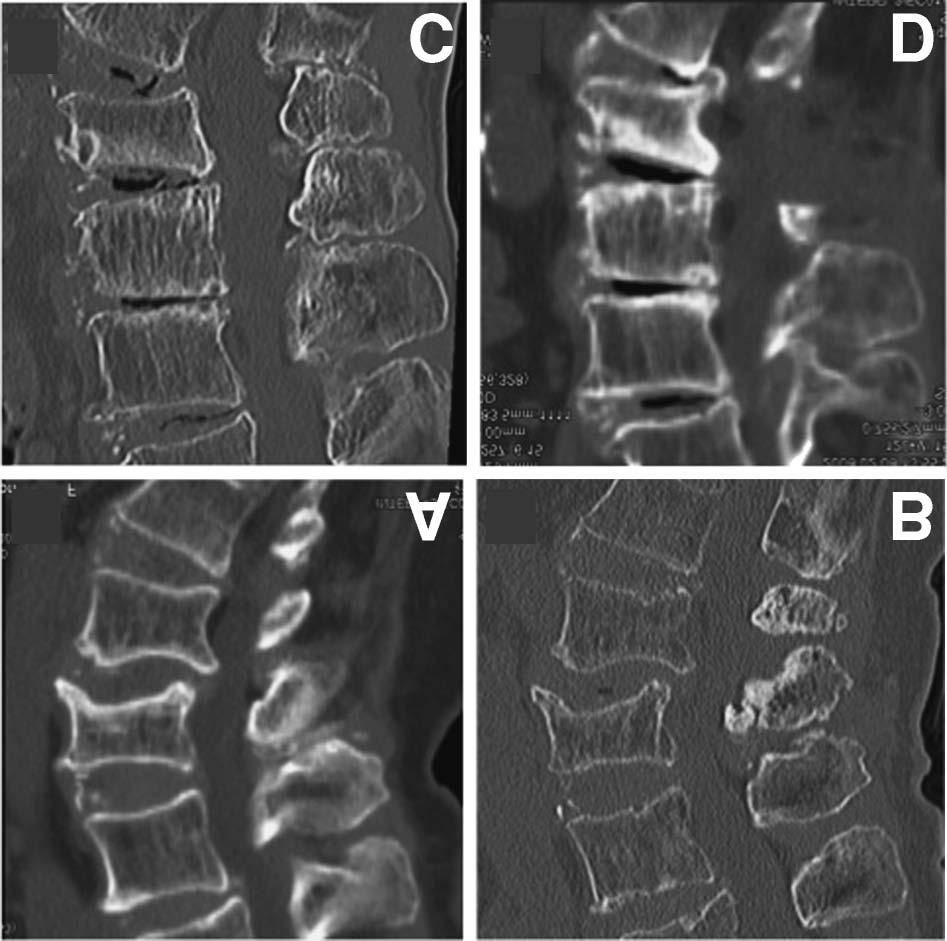 Radiculopathy Due to OVFs in the Lumbar Spine 487 developed at the spinal level adjacent to the OVFs.