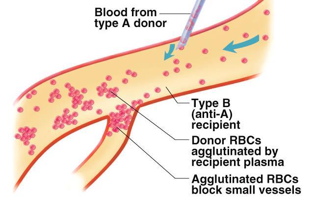 Transfusion of mismatched blood (transfusion reaction) If blood group A is given to a person whose blood group is B, donor RBCs will be attacked by antibodies (anti A agglutinin) which are already