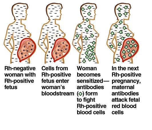 father mother Problems associated with Rh antibodies in pregnancy: Rh- woman with an Rh+ fetus or