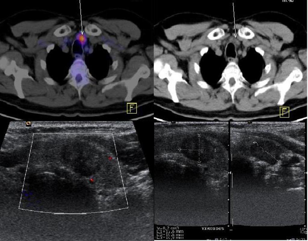 Fig. 8: Axial PET-CT scan shows hypermetabolic