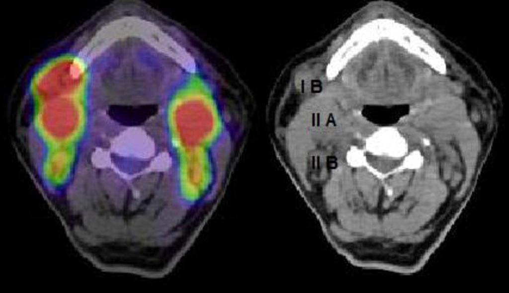 Imaging findings OR Procedure details Between February 2009 and August 2009, we perform 598 FDG-18 PET-CT studies, of those, we select 20 patients with head and neck lymphadenopathy and perform high