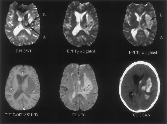 Linfante et al MRI in ICH Within 2 Hours From Symptom Onset 2265 Figure 1.